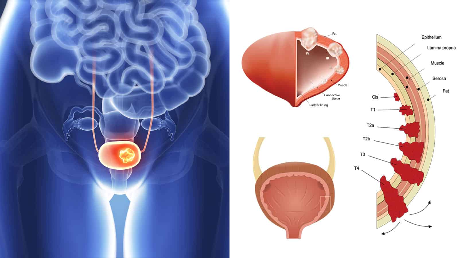 15 Hidden Signs of Bladder Cancer to Never Ignore