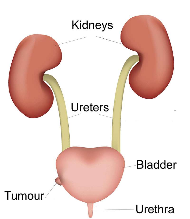 39+ Bladder Cancer Symptoms And Causes Gif