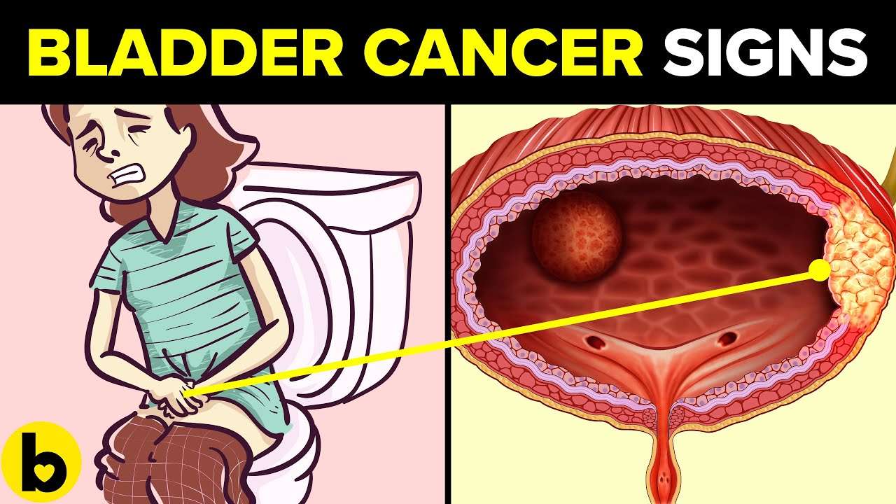 5 Early Signs of Bladder Cancer Mostly Ignored By People ...