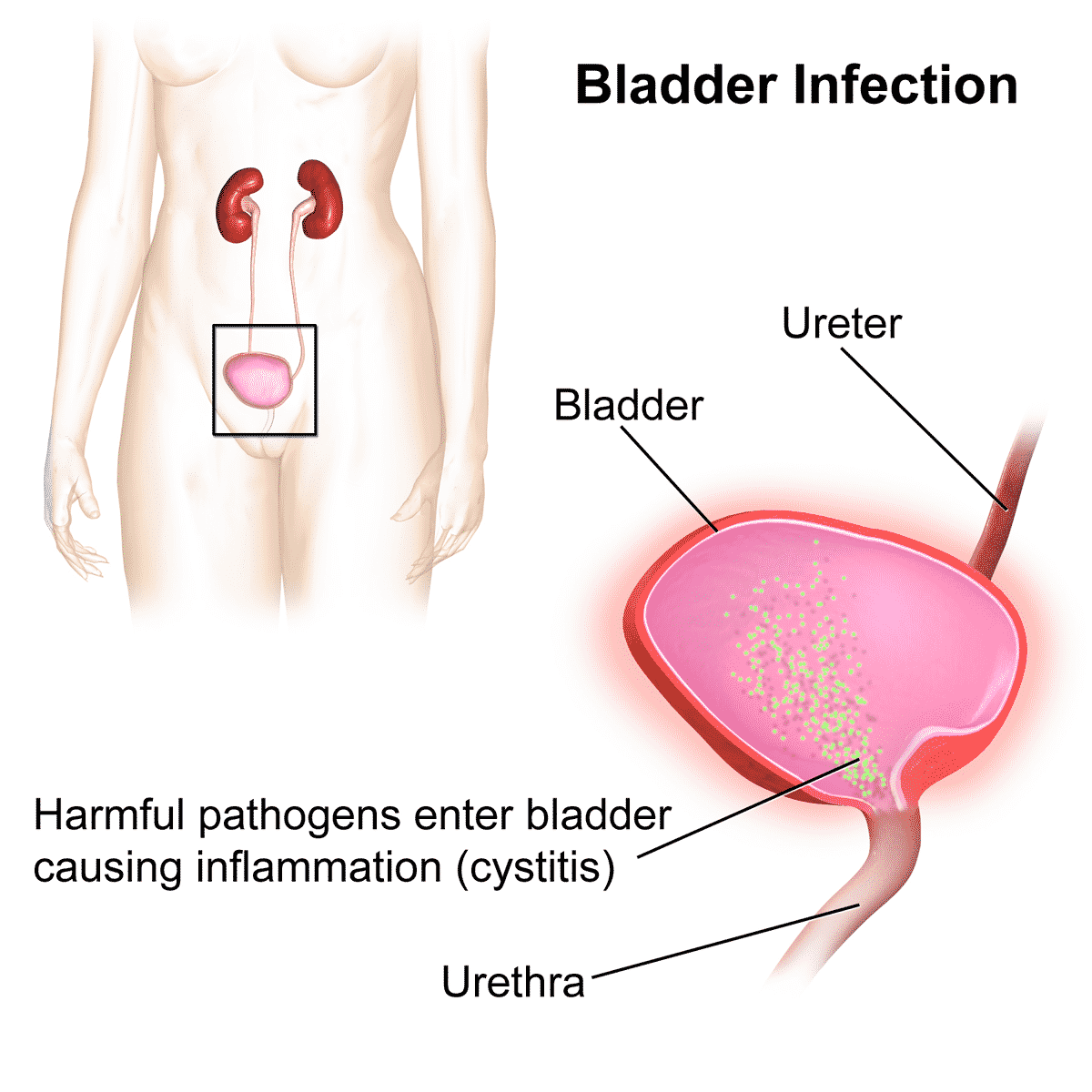 5 Things You Should Know About Urinary Infections