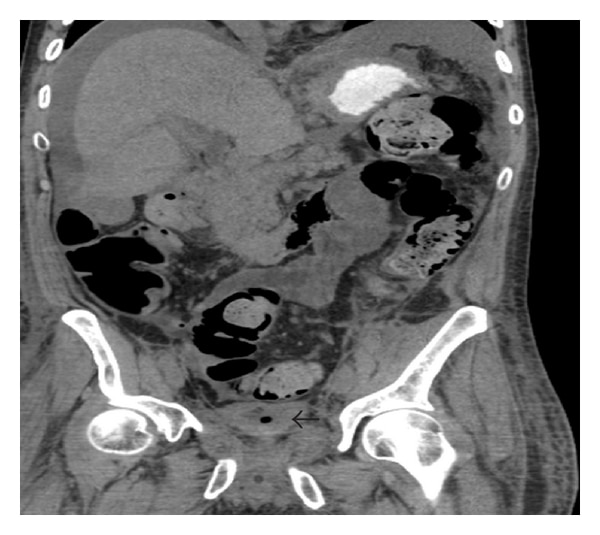A Rare Presentation of AKI: Gastric Infiltration of the Bladder Wall