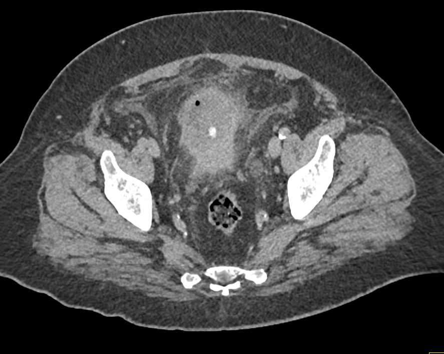 Aggressive Bladder Cancer with Bilateral Hydronephrosis ...