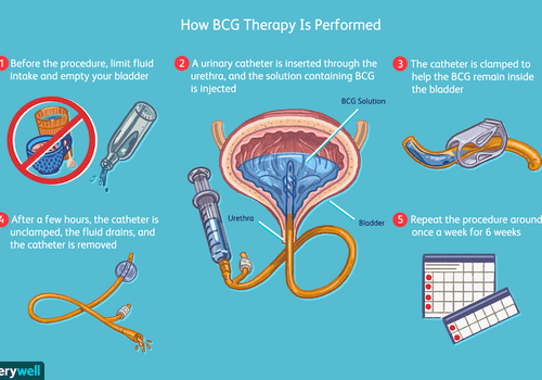BCG Immunotherapy: Uses, Procedure, Precautions, and Side Effects