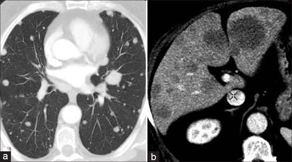 Bladder Cancer Lung Metastasis