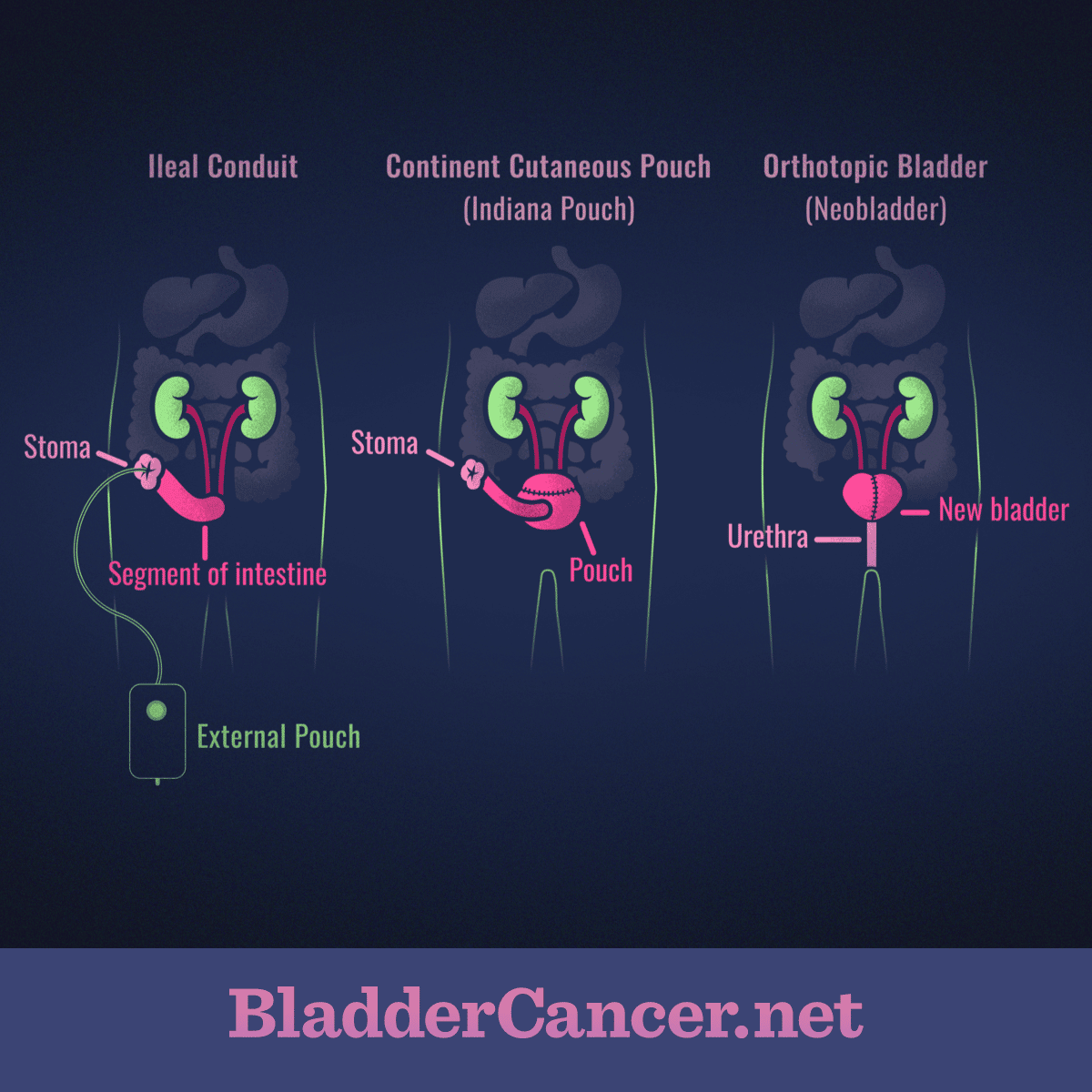 Bladder Cancer Reconstructive Surgery &  Types of Urinary Diversions