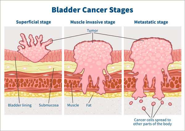 Bladder Cancer Survival: The Importance of Early Detection ...
