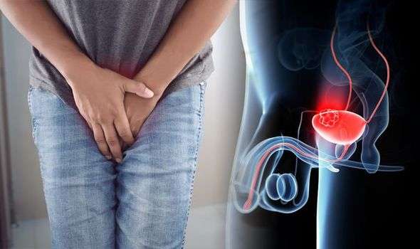 Bladder cancer symptoms: The most overlooked sign of the ...