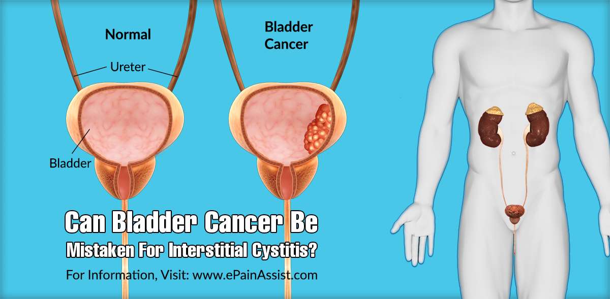 Can Bladder Cancer Be Mistaken For Interstitial Cystitis?