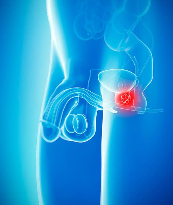 Can Enlarged Prostate Cause Blood In Urine