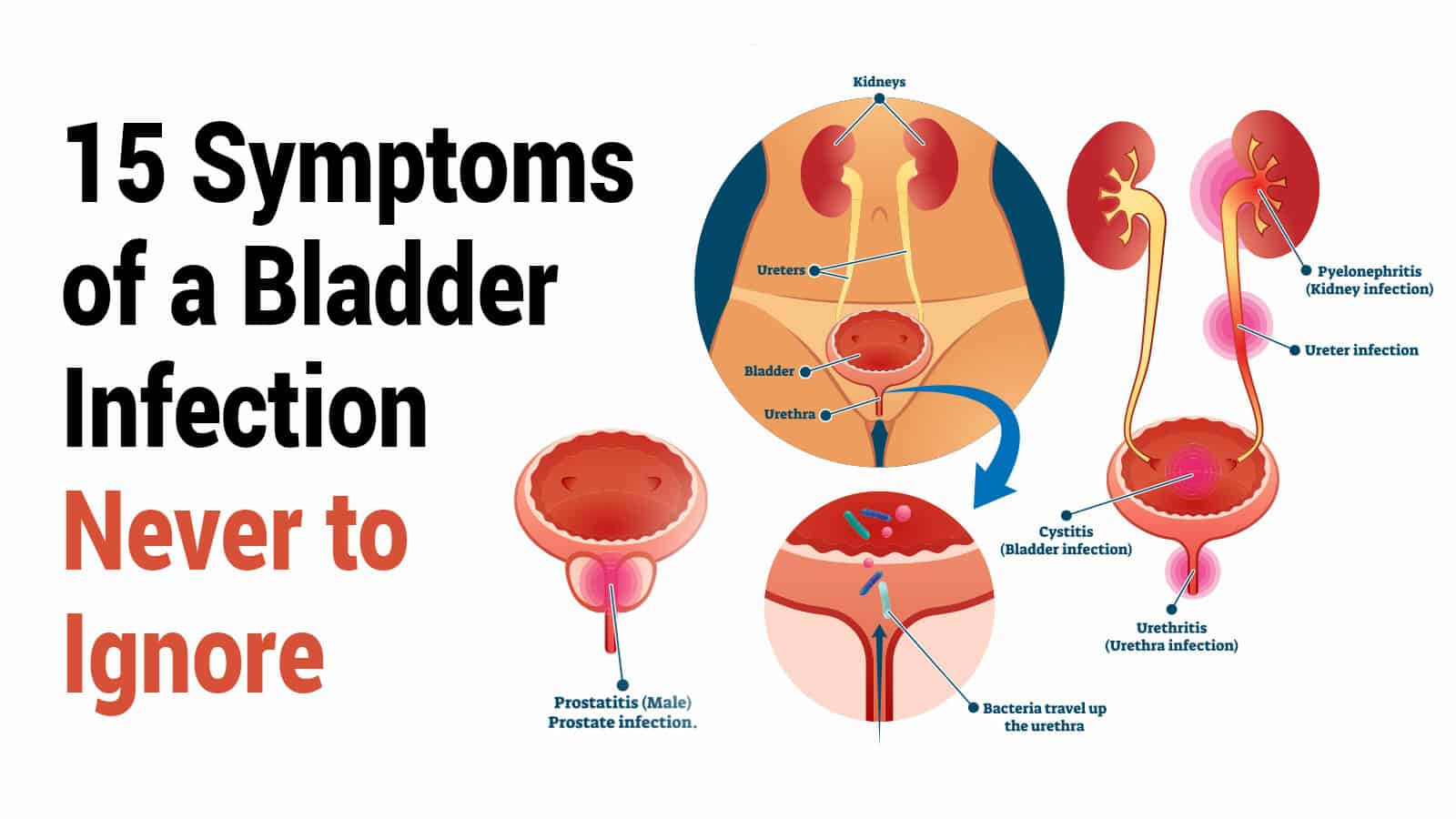 Can You Have A Bladder Infection Without Symptoms ...