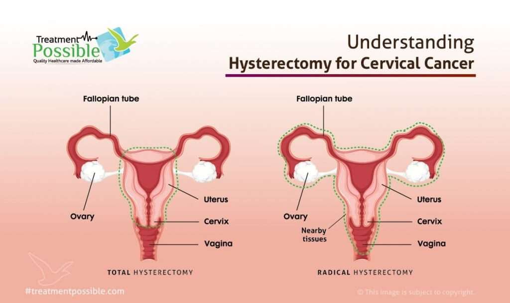 Cervical Cancer Treatment In India At Affordable Cost