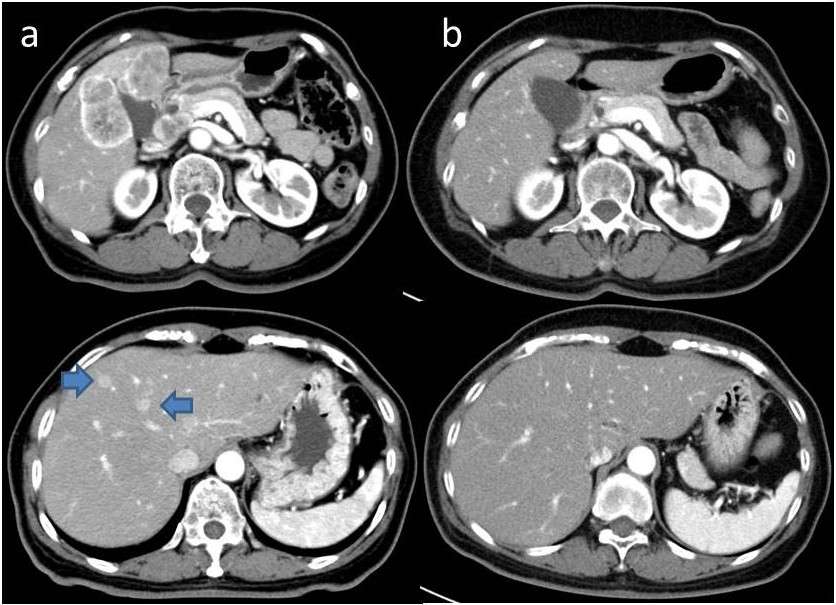 Changes in CT images of the gallbladder cancer and liver ...