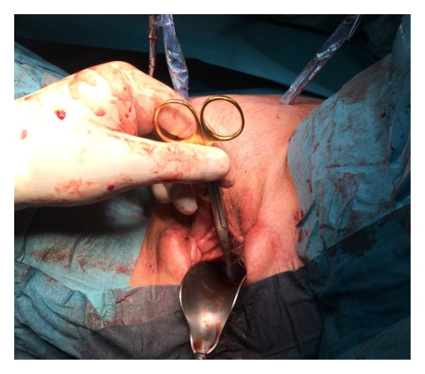 Coating of Mesh Grafts for Prolapse and Urinary Incontinence Repair ...