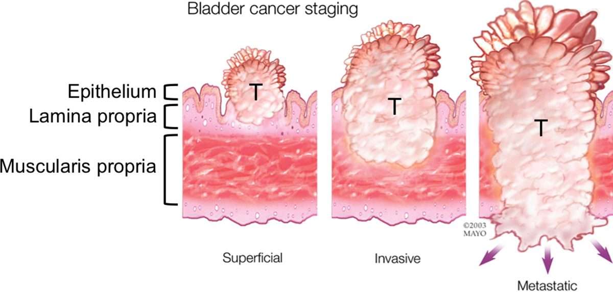 Complications of Intravesical BCG Immunotherapy for Bladder Cancer ...