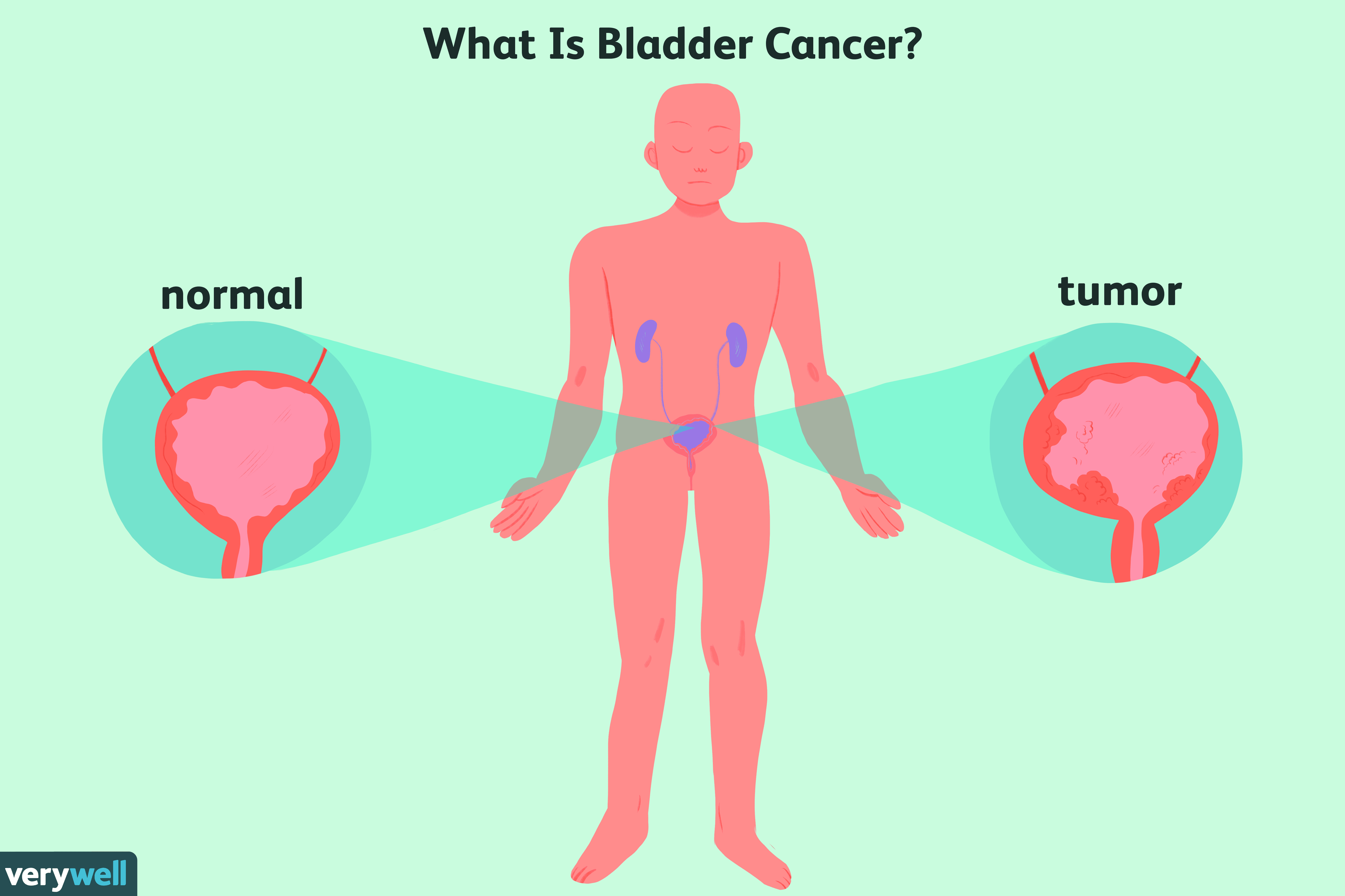 Coping With Bladder Cancer