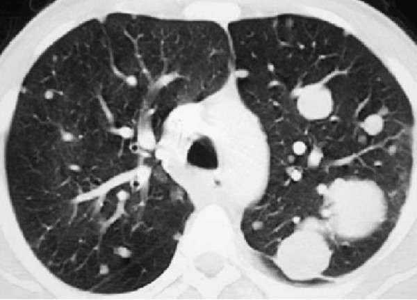 CT scan view of pulmonary metastasis.