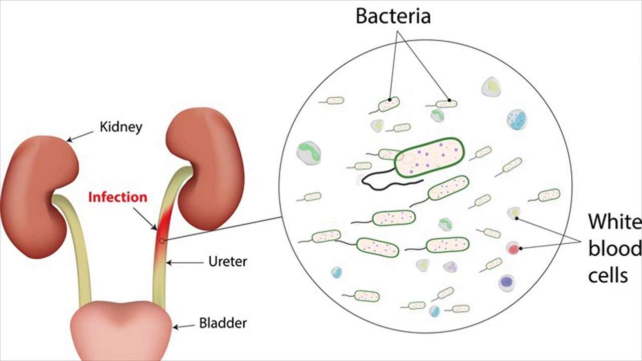 Difference Between Upper and Lower Urinary Tract Infection ...