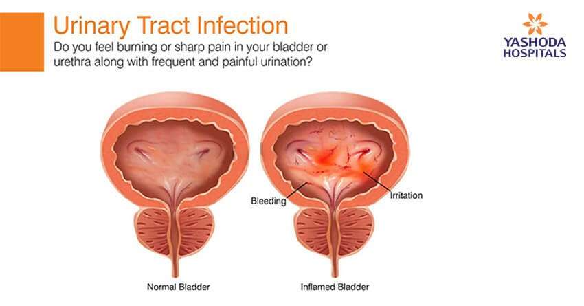 Do you feel burning or sharp pain in your bladder or urethra?