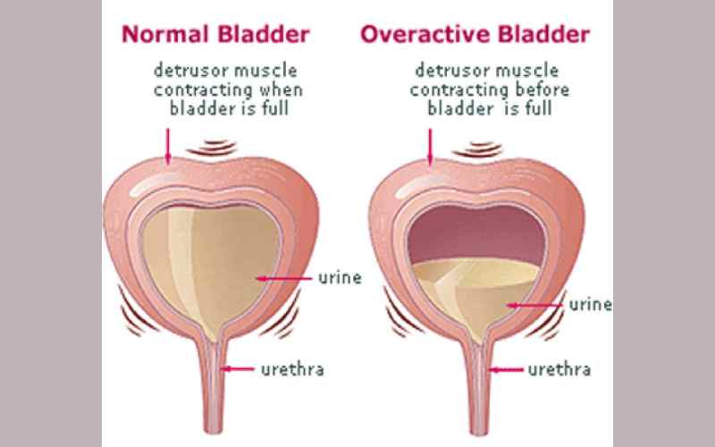 Do you have an overactive bladder?