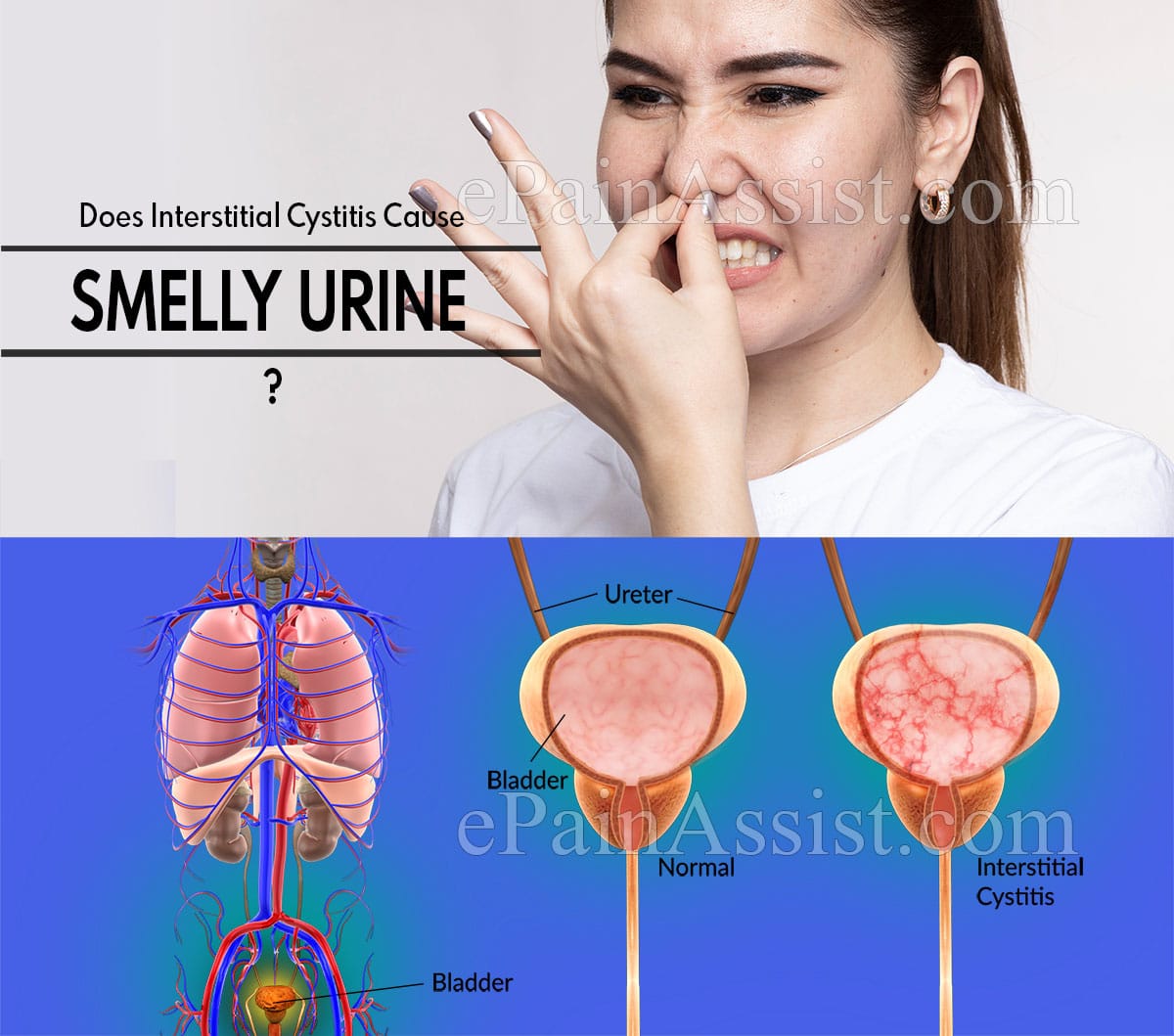 Does Interstitial Cystitis Cause Smelly Urine &  Can A Urine Test Detect IC?