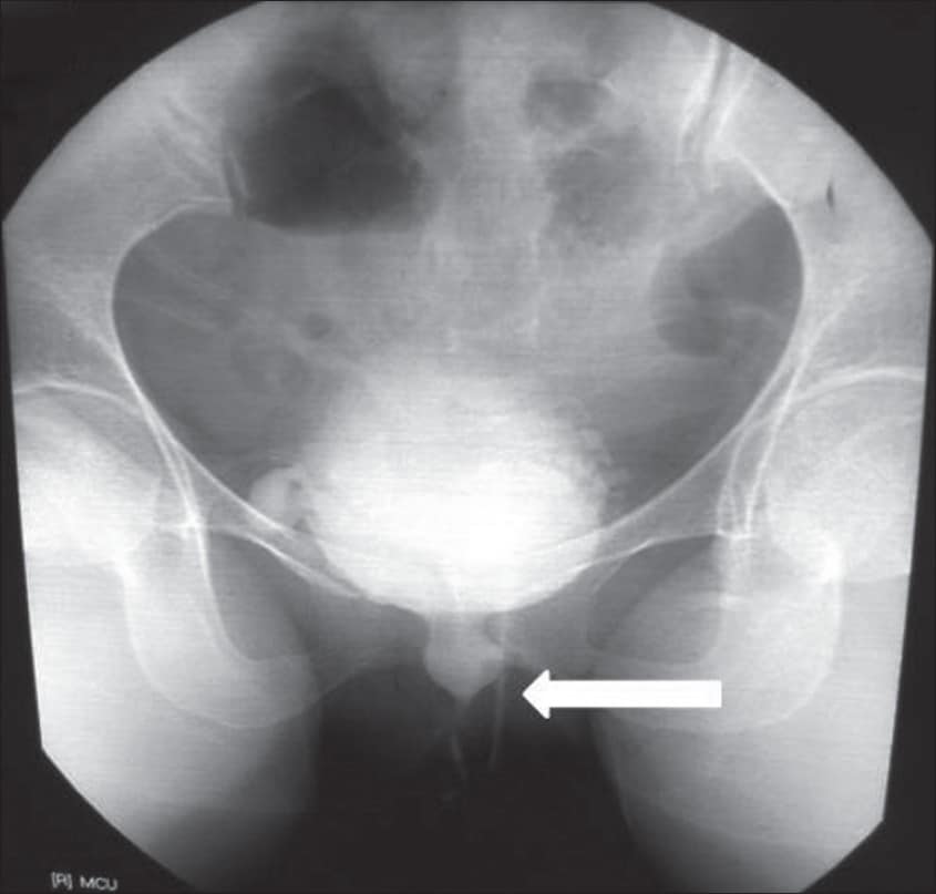 Dorsal onlay vaginal graft urethroplasty for female urethral stricture ...