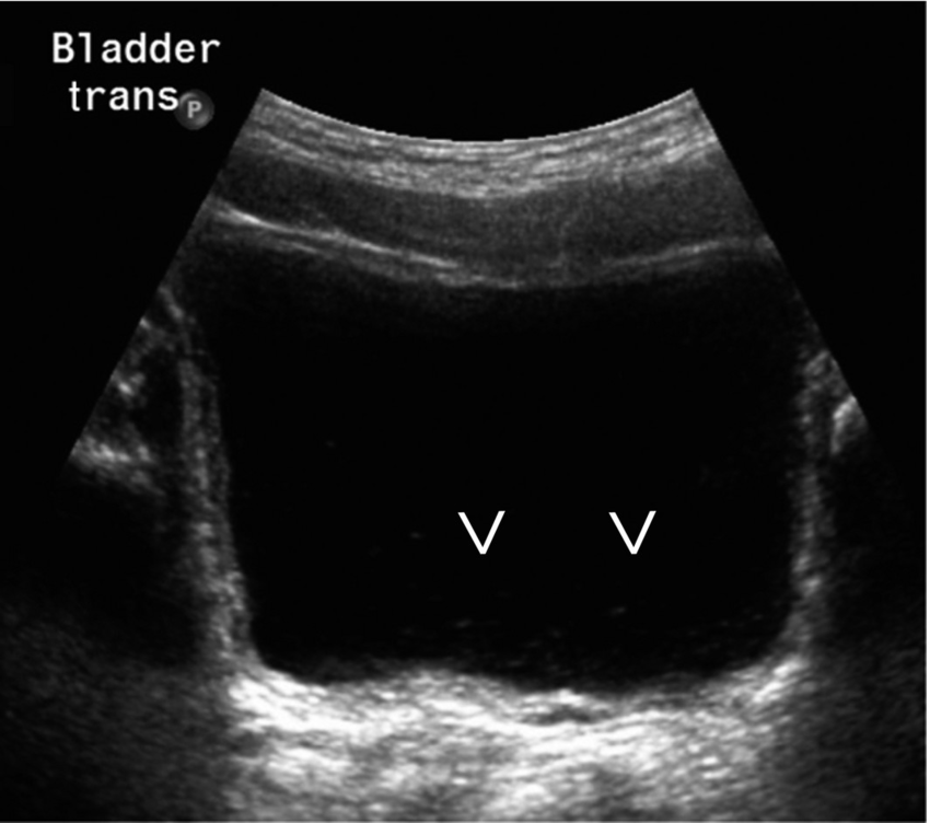 Echogenic debris can be seen in the urinary bladder ...