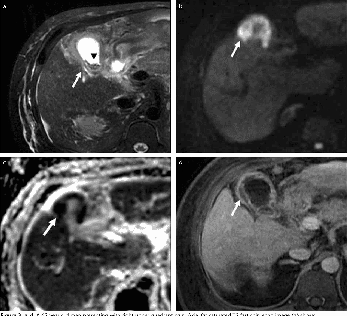 Figure 4 from MRI of gallbladder cancer.