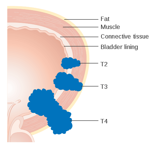 File:Diagram showing invasive bladder cancer CRUK 443.svg