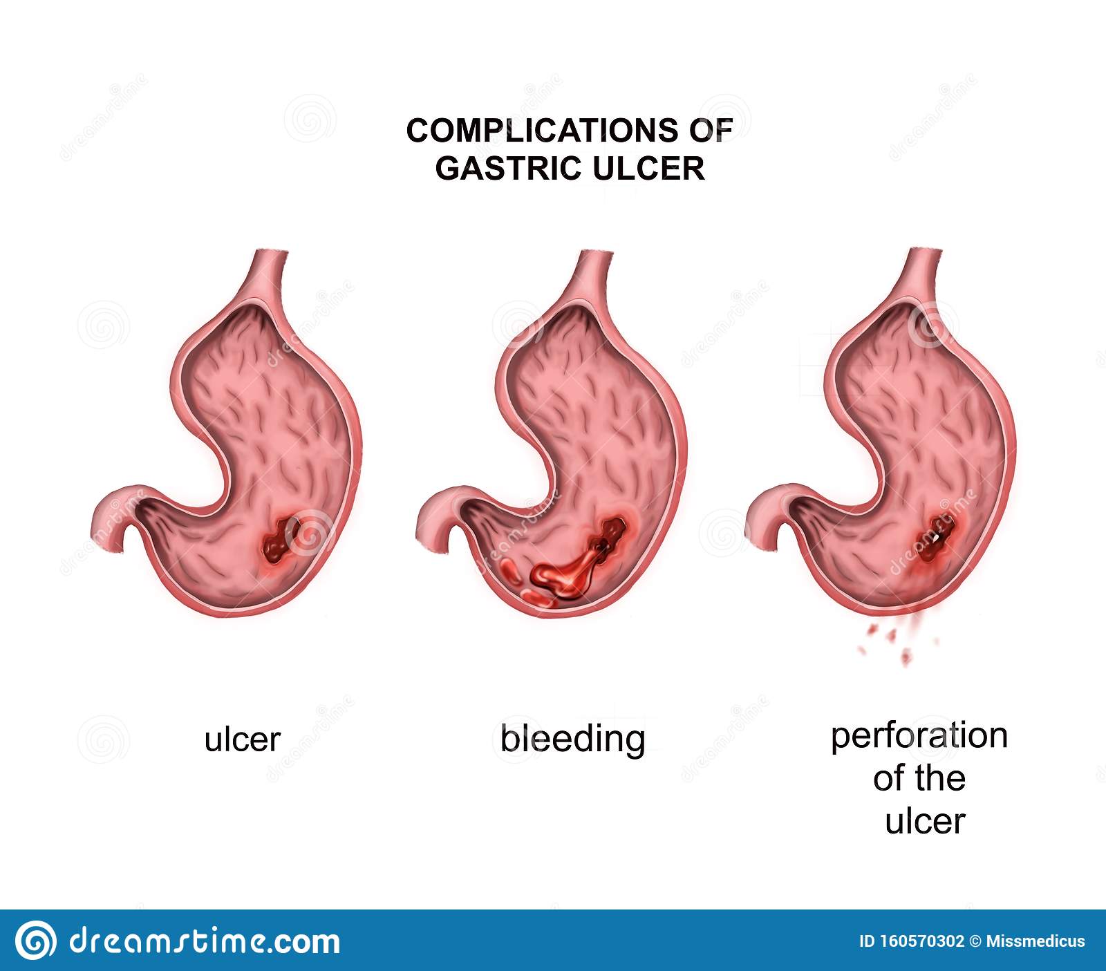Growth of Cancer in the Bladder Stock Illustration