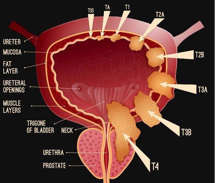 Illustration of different pathological stages of bladder ...