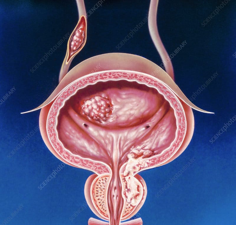 Male urogenital cancers, illustration