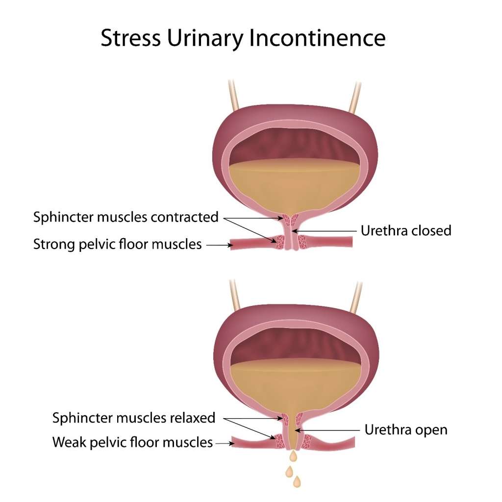 Managing vs. Treating Urinary Incontinence (UI)