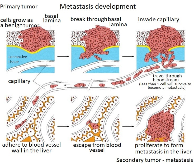 Metastases in cervical cancer patients