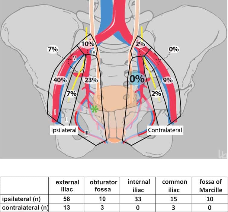 Pelvic Lymph Node Dissection may be Limited on the Contralateral Side ...
