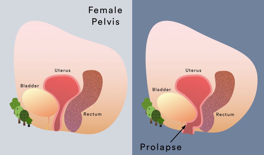 Pelvic Organ Prolapse Symptoms &  Treatment