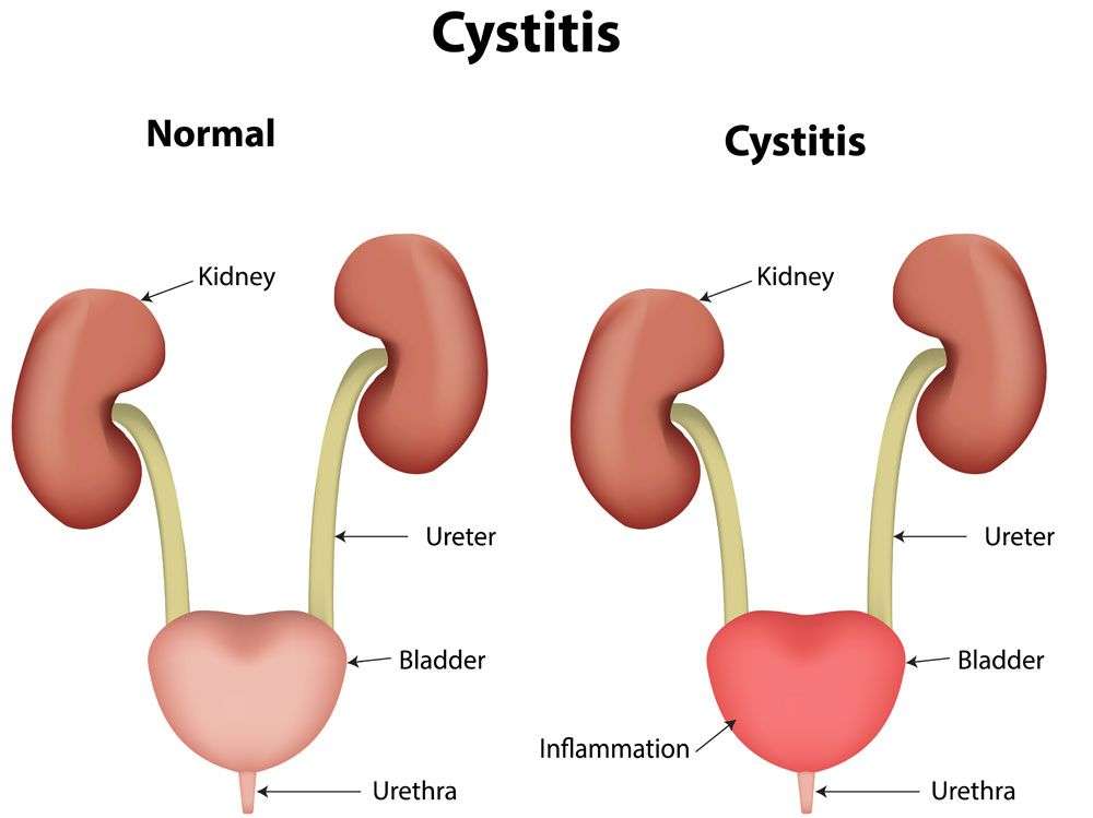 Pin on Interstitial Cystitis