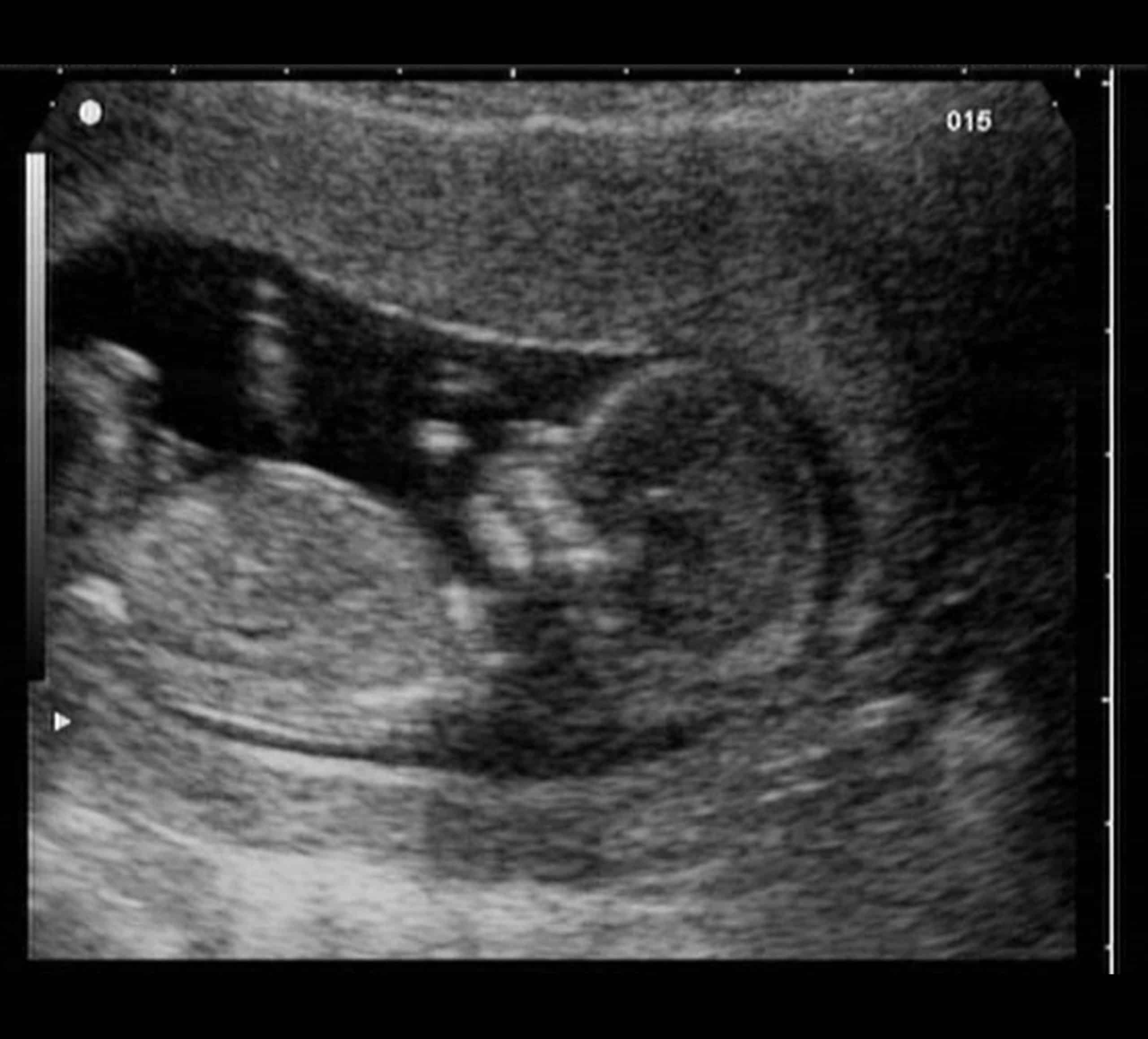 Prenatal Ultrasound Los Angeles