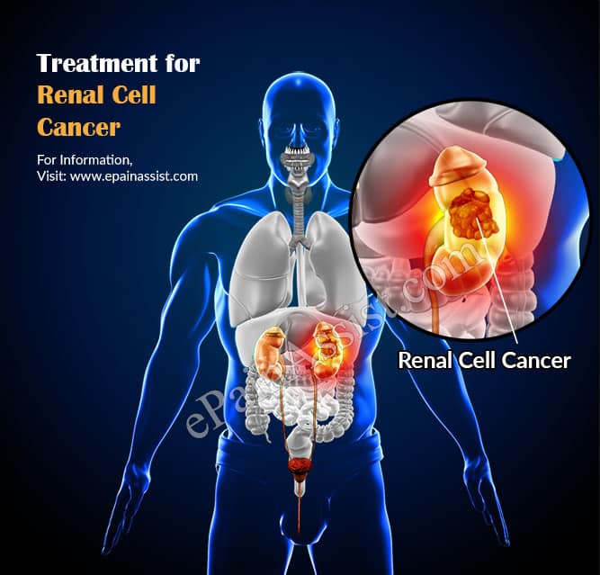 Renal Cell Cancer: Treatment, Complications, Prognosis