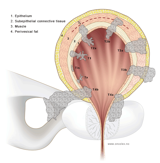 Staging of bladder cancer
