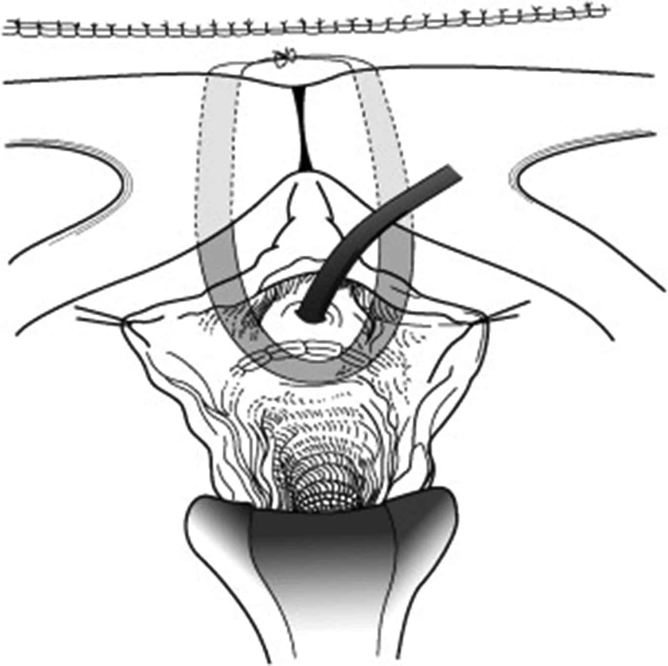 Surgery for Stress Urinary Incontinence