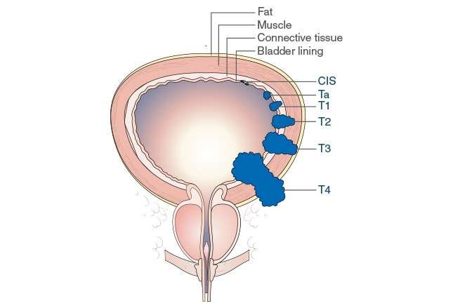 Urinary Bladder Cancer: What You Need to Know