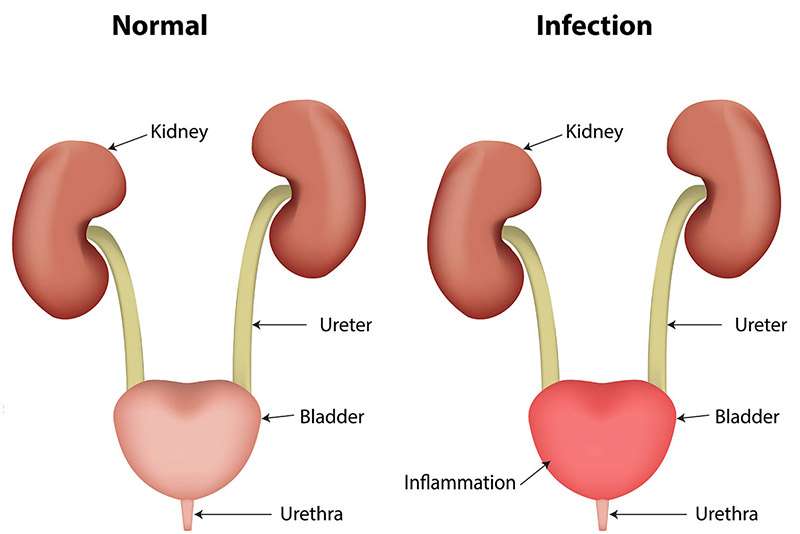 Urinary tract infection: symptoms and treatments of urinary tract ...