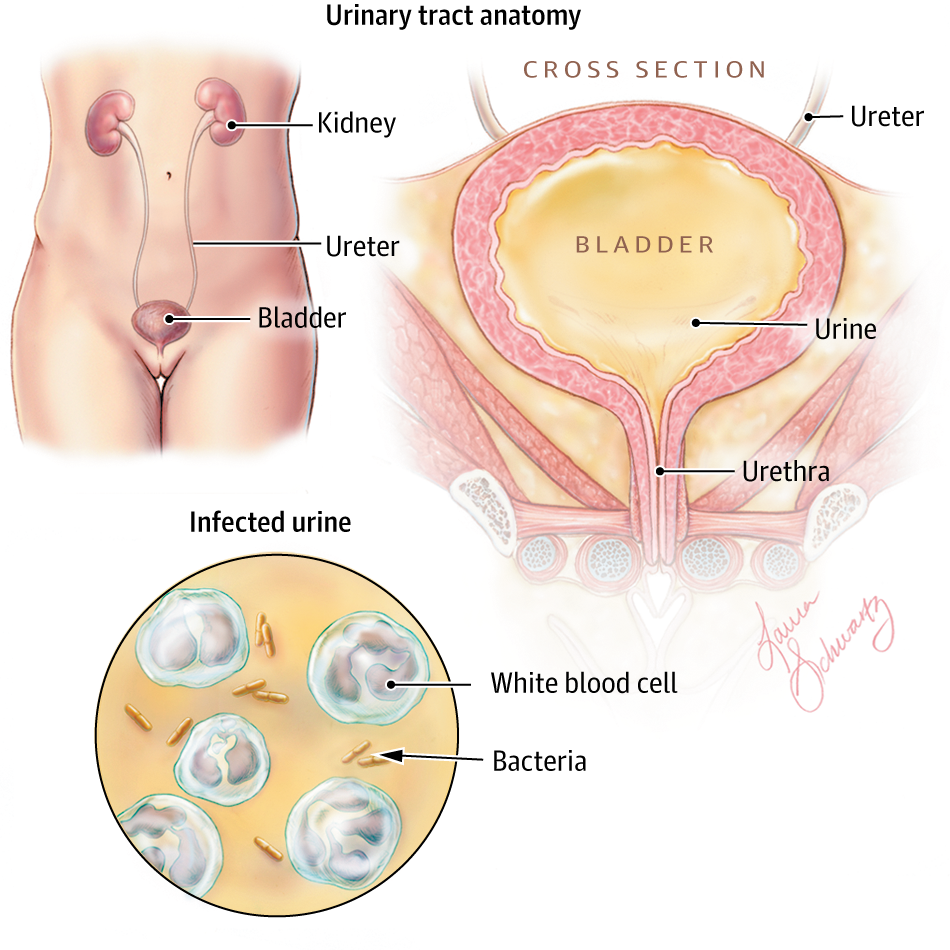 Urinary Tract Infections in Older Women