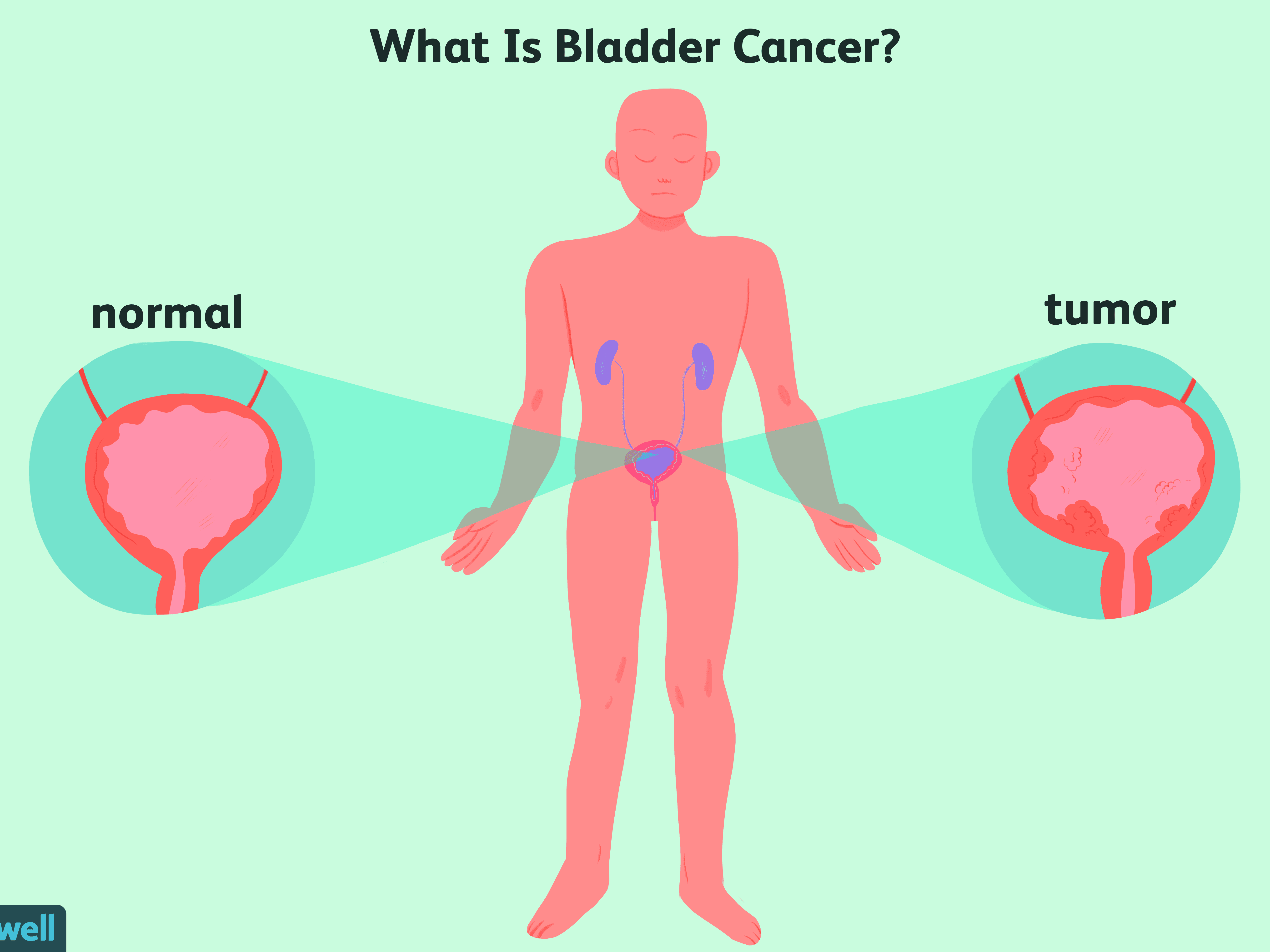 Verywell Family: How Long Can You Live With Bladder Cancer
