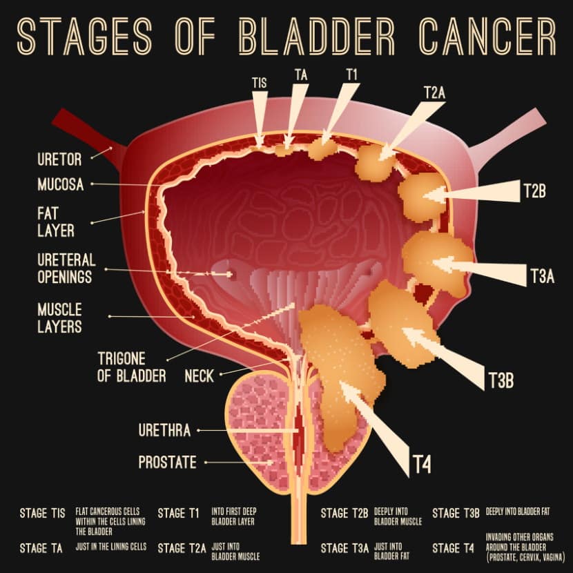 What Are The Symptoms Of Bladder Cancer In A Female : Non